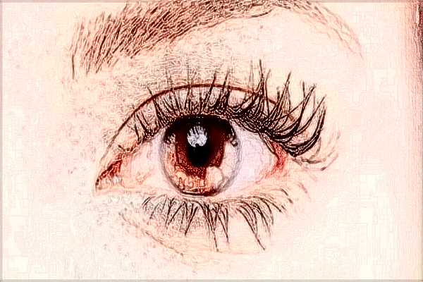 2024無錫市第二人民醫(yī)院去眼袋做的怎么樣_案例+價(jià)格