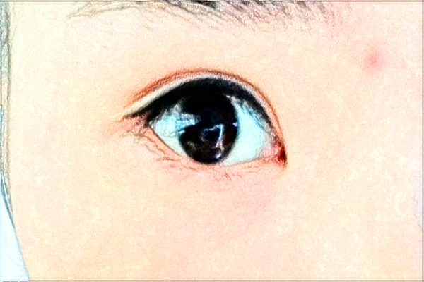 六安市人民醫(yī)院激光去除眼袋有沒有作用_做的怎么樣