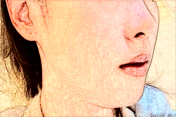 六安市人民醫(yī)院激光去除一顆老年斑需要多少錢_案例