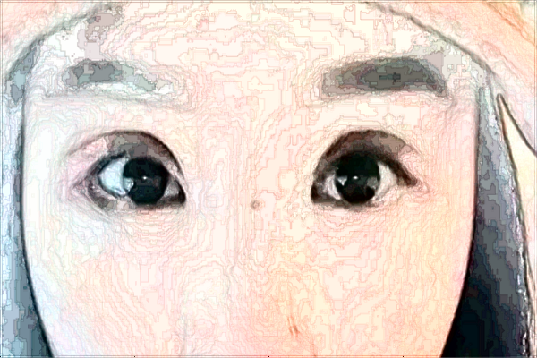 浙江省中醫(yī)院填淚溝做的好不好_填淚溝多長時(shí)間恢復(fù)好