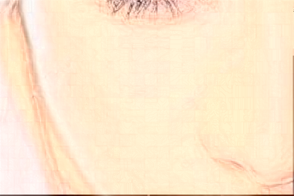 保定市第一中心醫(yī)院去胎記做的怎么樣_哪位醫(yī)生做得好