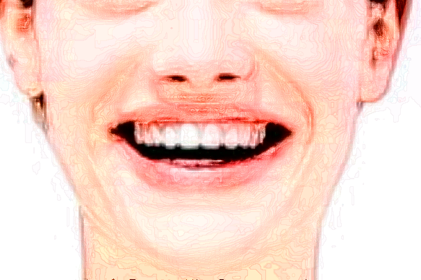 2024江蘇省口腔醫(yī)院瓷貼面怎么樣_案例+價(jià)格