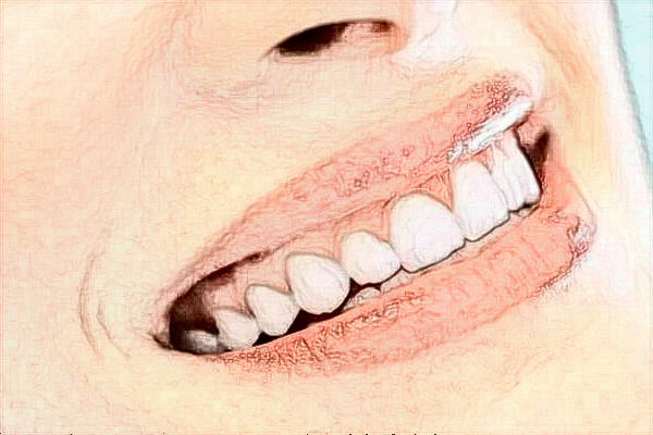 2024四川大學(xué)華西口腔醫(yī)院種植牙價格多少?種植牙案例分享