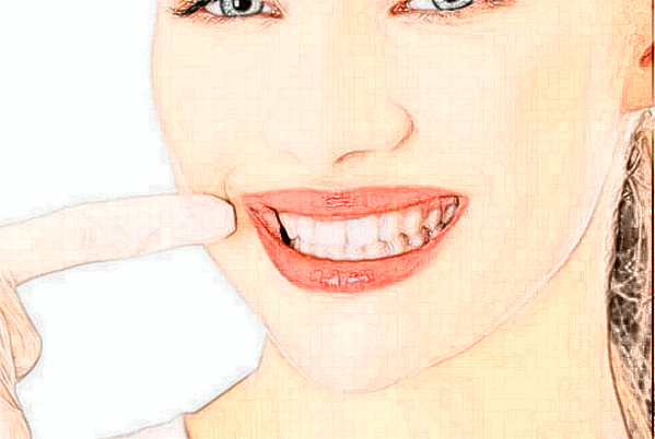 2024重慶醫(yī)科大學(xué)附屬口腔醫(yī)院牙齒美白需要多少錢(qián)_案例分享