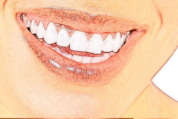 2024重慶醫(yī)科大學附屬口腔醫(yī)院隱適美需要多少錢_案例分享