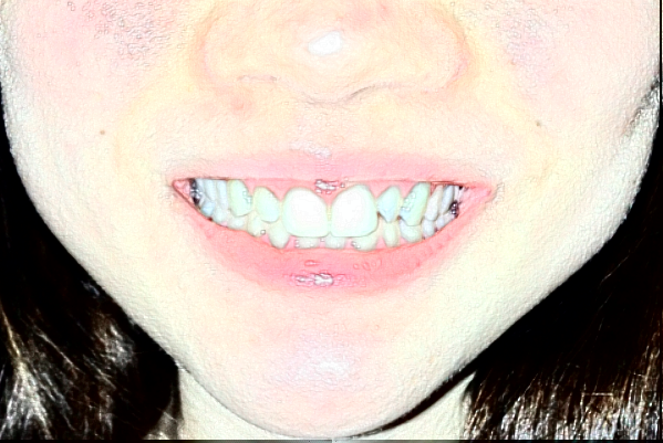 2024重慶醫(yī)科大學(xué)附屬口腔醫(yī)院鑲牙需要多少錢_案例分享