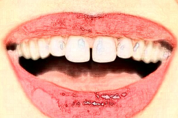 2024重慶醫(yī)科大學(xué)附屬口腔醫(yī)院牙冠怎么樣_牙冠會(huì)磨損嗎