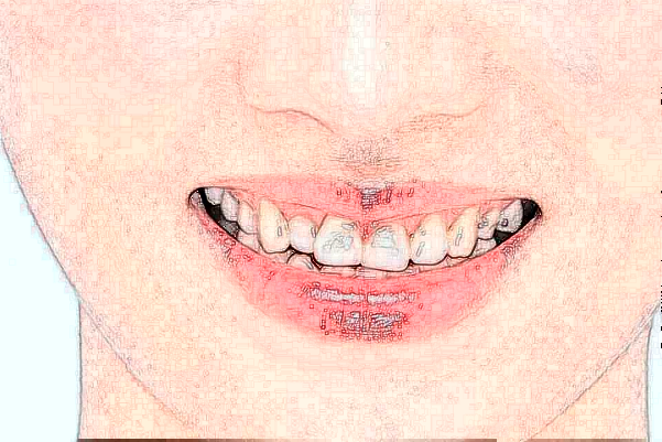 2024重慶醫(yī)科大學(xué)附屬口腔醫(yī)院牙冠怎么樣_牙冠會(huì)磨損嗎