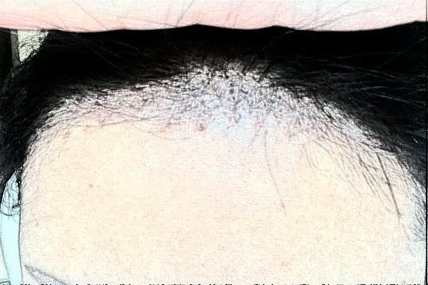 　　發(fā)際線不好看、大量脫發(fā)導致禿頂?shù)那闆r等，會給朋友們帶來很大的煩惱，這種情況可以選擇植發(fā)手術來，大連醫(yī)科大學附屬第一醫(yī)院做植發(fā)的技術比較不錯，根據(jù)大連地區(qū)網絡檢索的結果，比較常見的是發(fā)際線價格一般會在1100-38000元左右不等，比較常見的頭頂加密植發(fā)價格一般會在900-9300元左右不等，以上給出的價格僅供于參考，具體詳細的價格還需要到醫(yī)院找醫(yī)生進行面診之后來獲取。  　　1、2024大連醫(yī)科大學附屬第一醫(yī)院植發(fā)案例  　　很多年前自己一直脫頭發(fā)，其實這也屬于正常的反應，因為頭發(fā)都會有一個新陳代謝，隨著時間的增加，自己的頭發(fā)脫的有點多，每一次洗頭發(fā)的時候都掉一大把，當時也沒有太在意，一次無意間發(fā)現(xiàn)了自己頭頂?shù)念^發(fā)有一些稀少，這才意識到了脫發(fā)的嚴重性，所以想通過植發(fā)手術來，在家人的陪同下來到了大連醫(yī)科大學附屬第一醫(yī)院，跟醫(yī)生說明了自己掉發(fā)的情況，并且問了醫(yī)生能不能做植發(fā)手術，醫(yī)生采取診斷之后建議說可以做植發(fā)手術，所以配合了醫(yī)生的工作，整體手術操作大概用了不到三個小時左右的時間，術后就能夠看到一些植發(fā)的痕跡，在半個月之后直的頭發(fā)慢慢的長了出來，看到長出來的頭發(fā)自己的心情也愉悅了很多，終于不用擔心頭發(fā)稀少的問題帶來的困擾了。  　　2、2024大連醫(yī)科大學附屬第一醫(yī)院簡介  　　大連醫(yī)科大學附屬第一醫(yī)院整形美容科是一個集醫(yī)療、教學、科研、預防為一體的大型綜合性醫(yī)院，醫(yī)院包括有美容外科、整形外科、頜面美容外科、皮膚激光美容外科等，醫(yī)院開展的手術項目有先天性和創(chuàng)傷性的畸形修復、除皺、乳房整形、減肥、面部年輕化抗衰老、植發(fā)、手術、手術等多個項目，醫(yī)院多年的發(fā)展結合了先進的技術和設備儀器，建立了一個重大特色的項目合作單位，并定期會派專業(yè)的醫(yī)護人員進行整形美容技術學術交流和研討，為廣大女性朋友在求美的道路上制定個性化的醫(yī)美服務，醫(yī)院內的醫(yī)生都有著先手的操作手法，組建了一支技術精湛的醫(yī)生團隊，會為女性朋友在秋美的道路上所需求，進行個性化的設計和診斷，得到了很多朋友們的一致好評。