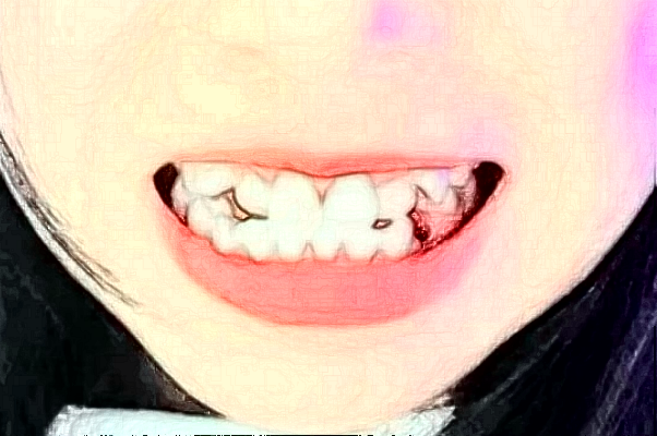 2024四川大學(xué)華西口腔醫(yī)院洗牙怎么樣_案例+價(jià)格展示