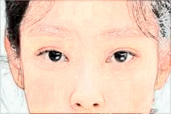 金華市中心醫(yī)院半飛秒做的好嗎_案例+價(jià)格