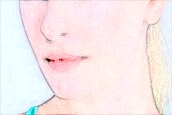 哈爾濱醫(yī)科大學(xué)附屬第一醫(yī)院光子嫩膚怎么樣【光子嫩膚案例】