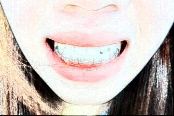 金華市中心醫(yī)院補牙做的咋樣_案例分享