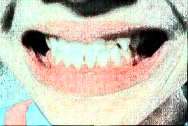 四川大學(xué)華西口腔醫(yī)院鑲牙做的怎么樣_哪個醫(yī)生做的比較好