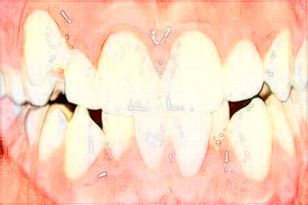 2024南寧303醫(yī)院種牙怎么樣?種—顆牙齒多少錢?