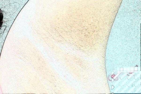 徐州市中心醫(yī)院去狐臭怎么樣_價(jià)格+案例分享