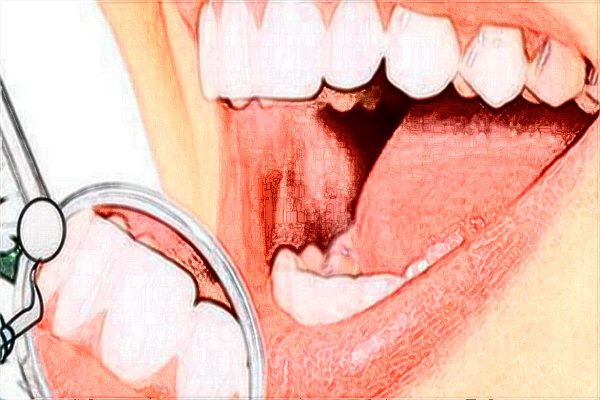 2024中山大學附屬第一醫(yī)院矯正牙齒價格?矯正牙齒要多久