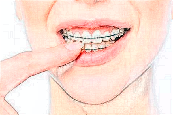 中山大學(xué)附屬第一醫(yī)院正畸醫(yī)生好嗎?2024正畸醫(yī)生收費(fèi)價(jià)格