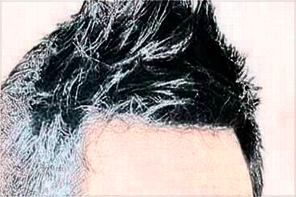 中山大學(xué)附屬第一醫(yī)院植發(fā)選哪個科?植發(fā)的危害和后遺癥