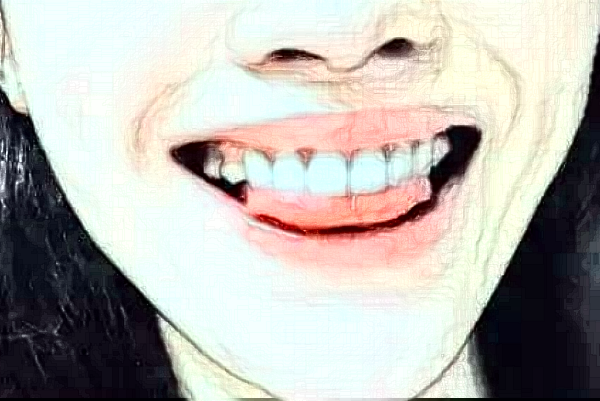 天津市口腔醫(yī)院齙牙矯正怎么樣?術(shù)后案例反饋