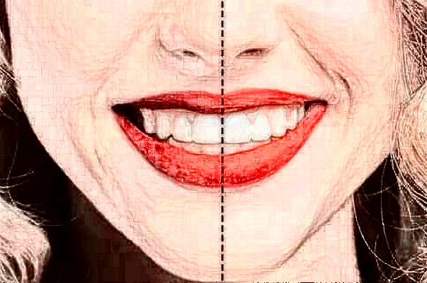 天津市口腔醫(yī)院美白牙齒做的好嗎_案例日記分享