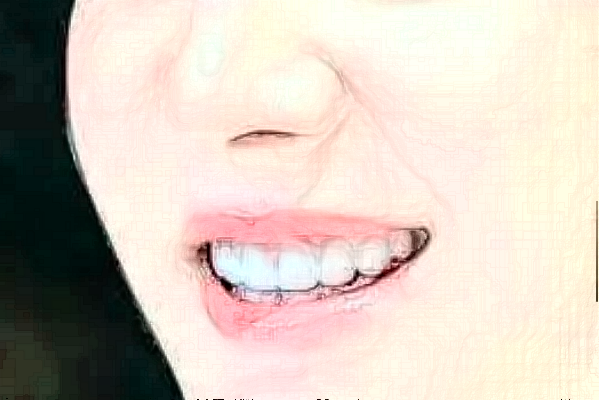 哈爾濱醫(yī)科大學(xué)附屬第一醫(yī)院補(bǔ)牙價格多少_做的怎么樣