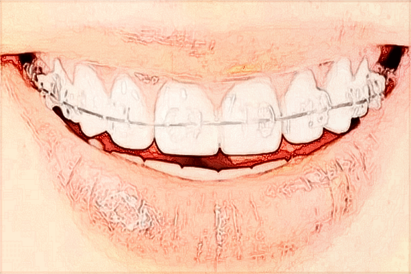 廣東省中醫(yī)院珠海醫(yī)院洗牙好嗎?洗牙能讓牙齒變白嗎?