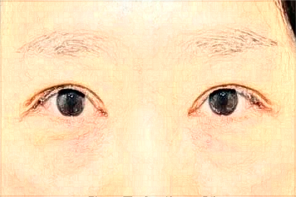 2024徐州市中心醫(yī)院激光消除黑眼圈做的好嗎？體驗(yàn)案例分享