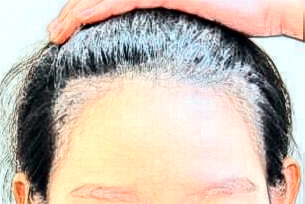 2024天津人民醫(yī)院植發(fā)價目表(價格表)_口碑怎么樣