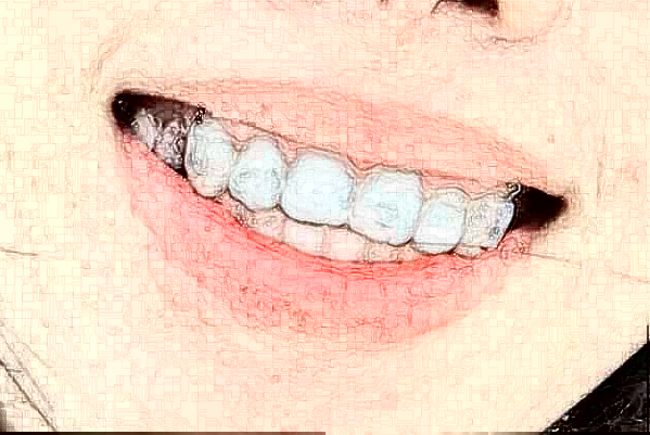 2024蘇州第四人民醫(yī)院牙齒矯正價目表(價格表)怎么樣