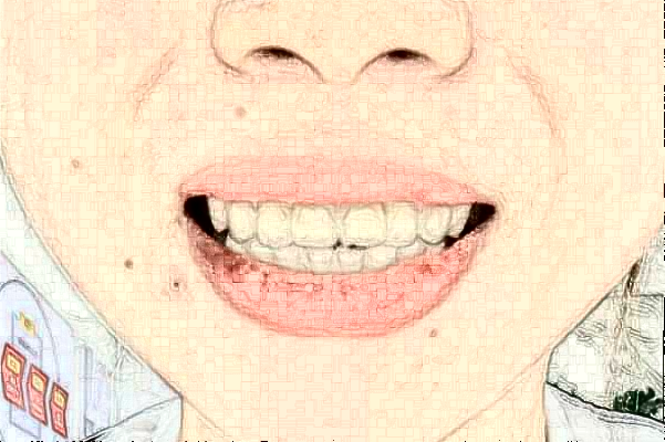 2024金華市中醫(yī)院口腔科乳牙拔除怎么樣【案例日記分享】