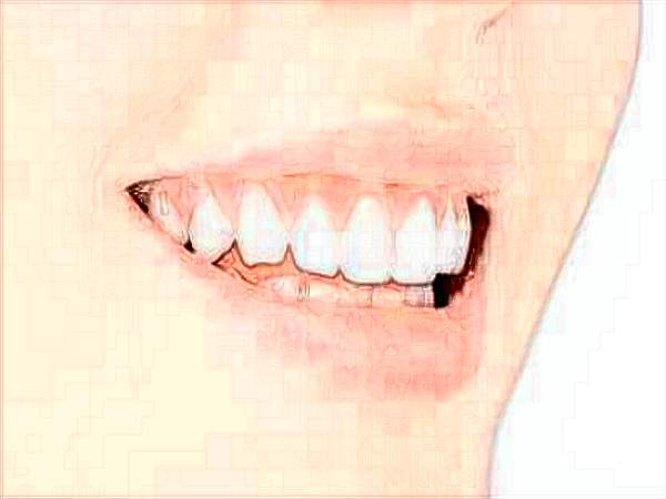 中山大學(xué)附屬口腔醫(yī)院洗牙怎么樣?洗牙對(duì)牙齒有傷害嗎