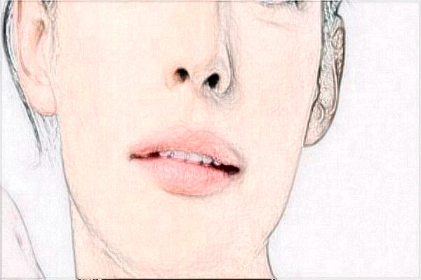 2024江蘇大學附屬醫(yī)院光子嫩膚手術怎么樣【光子嫩膚案例】