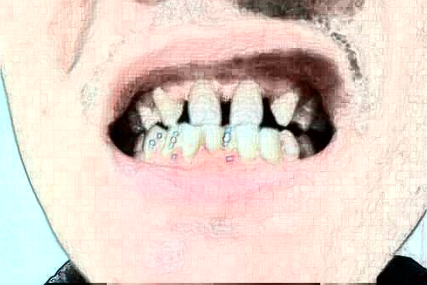 江蘇大學(xué)附屬醫(yī)院口腔科譚玉輝醫(yī)生技術(shù)好不好_做的怎么樣