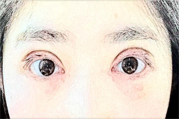 金華市中心醫(yī)院割雙眼皮做的好嗎_案例反饋