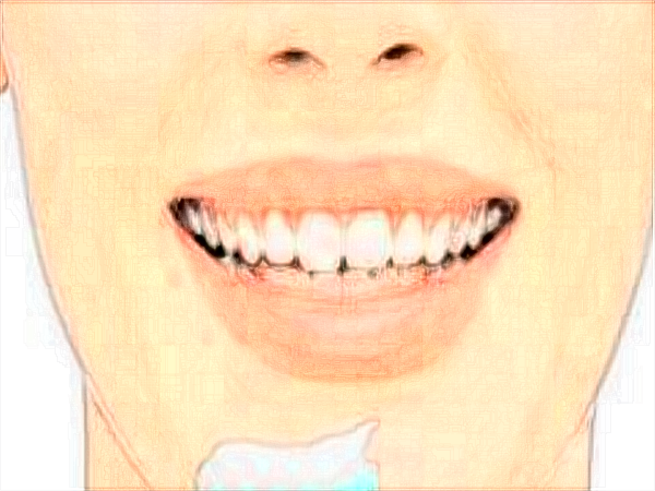 2024中山大學附屬口腔醫(yī)院牙齒美白價格?牙齒美白原理