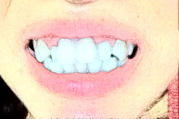 南京中大醫(yī)院口腔科牙齒修復做的好嗎?體驗日記分享