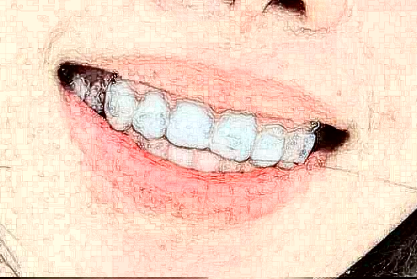 溫州醫(yī)學(xué)院附屬第二醫(yī)院口腔科地包天矯正價(jià)格表_醫(yī)生推薦