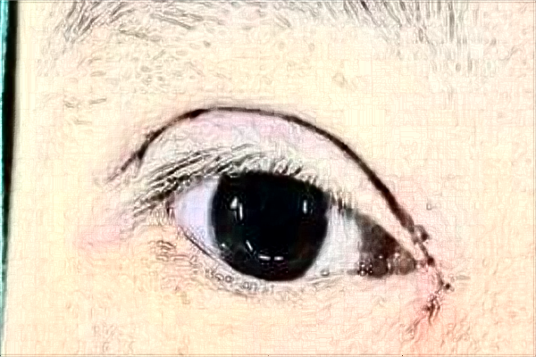 上海東方醫(yī)院割雙眼皮那個醫(yī)生做的好【雙眼皮案例】