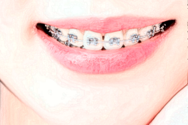 2024溫州醫(yī)學(xué)院附屬第二醫(yī)院口腔科正畸做的怎么樣_誰做的比較好