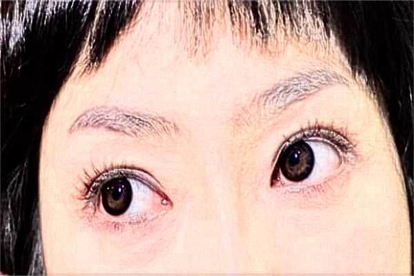 2024哈爾濱醫(yī)科大學附屬第一醫(yī)院做雙眼皮做的好嗎_雙眼皮整形日記分享