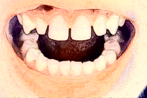 2024太原市中心醫(yī)院口腔科種植修復(fù)怎么樣?實測案例分享