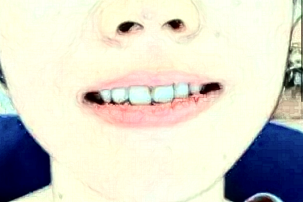 無錫市第一人民醫(yī)院口腔科種植牙修復怎么樣_整形日記分享