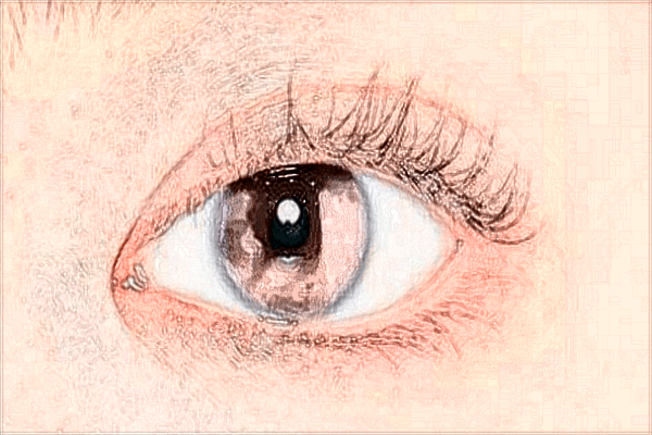 2024貴陽(yáng)醫(yī)學(xué)院附屬醫(yī)院全飛秒手術(shù)價(jià)格?全飛秒手術(shù)原理