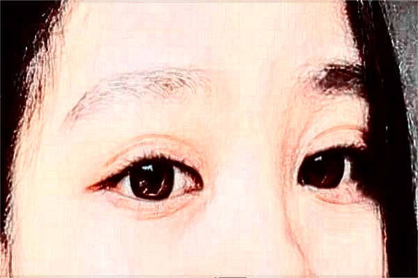 2024安徽省立醫(yī)院全飛秒激光多少錢？誰做得好