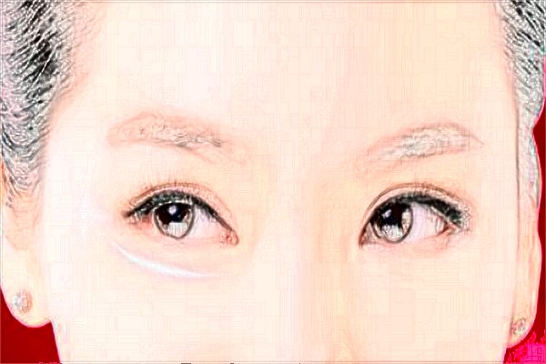 2024哈爾濱醫(yī)科大學附屬第一醫(yī)院去眼袋做的怎么樣_去眼袋手術(shù)有危害嗎