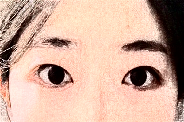 2024安徽省立醫(yī)院半飛秒多少錢(qián)?【半飛秒案例】