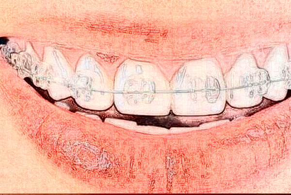 2024天津市第三中心醫(yī)院口腔科隱形矯正價(jià)目表(價(jià)格表)怎么樣