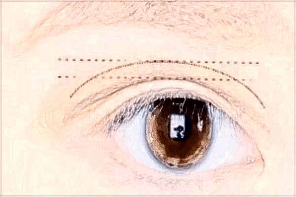 南寧303醫(yī)院近視手術(shù)需要休息幾天?2024激光近視手術(shù)價格