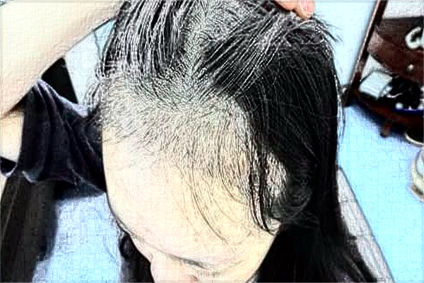 南通大學(xué)附屬醫(yī)院植發(fā)做的好嗎？誰做的好